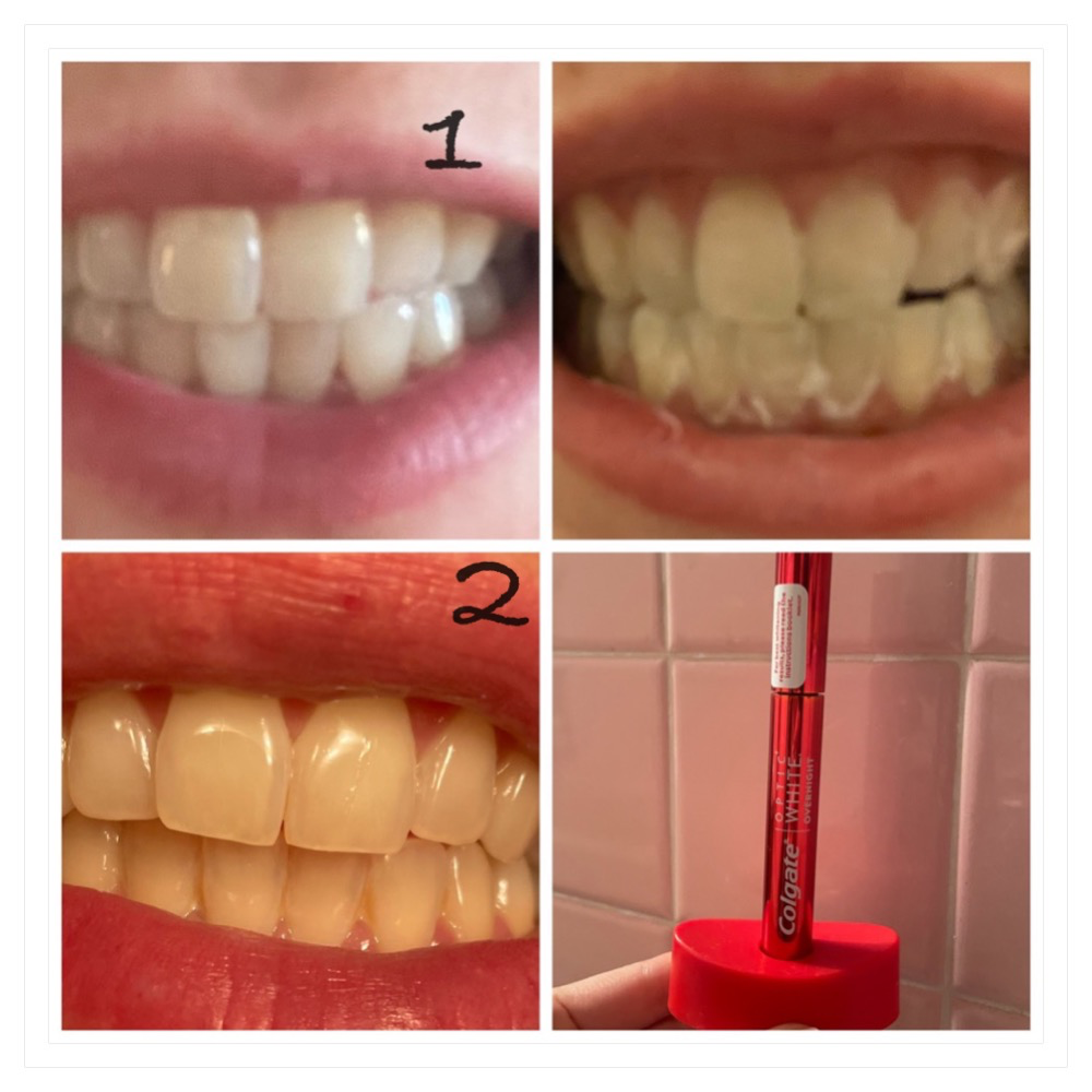 Before And After Optic White Overnight Review Colgate Max White